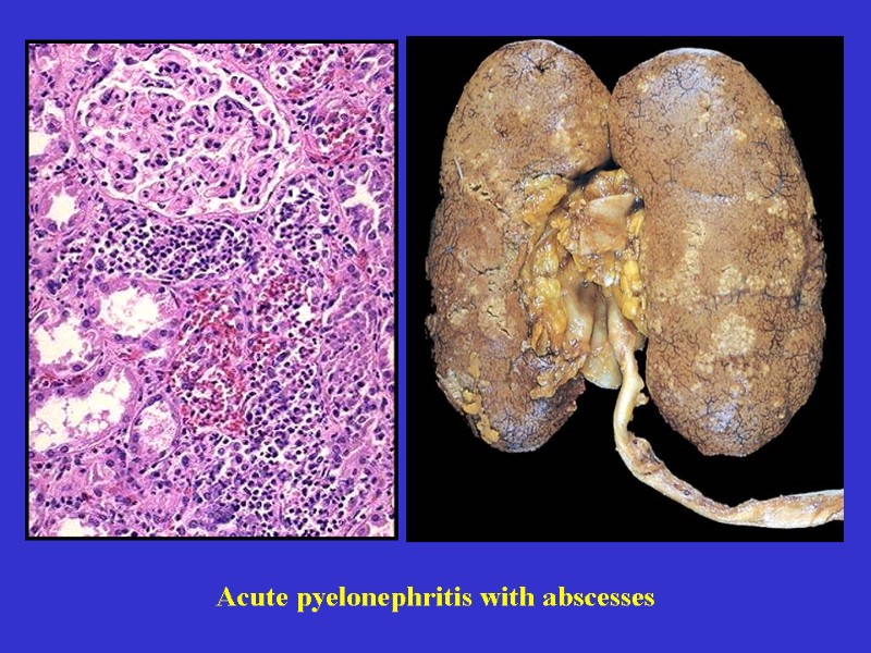 Acute pyelonephritis with abscesses